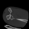 SPORK, NICO - 22.03.1976 - 02.08.2022 - CT obere Extremität - 17:59:38